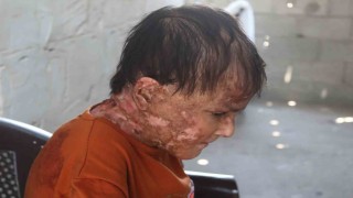Gazzede nadir cilt hastalığıyla mücadele eden genç kız: İyileşip elbise giymenin hayalini kuruyorum
