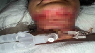 Gıdı estetiği sonrası nefes alamadı, boynundan acil solunum yolu açıldı