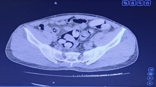 Midesinden 1 kilo uyuşturucu çıktı